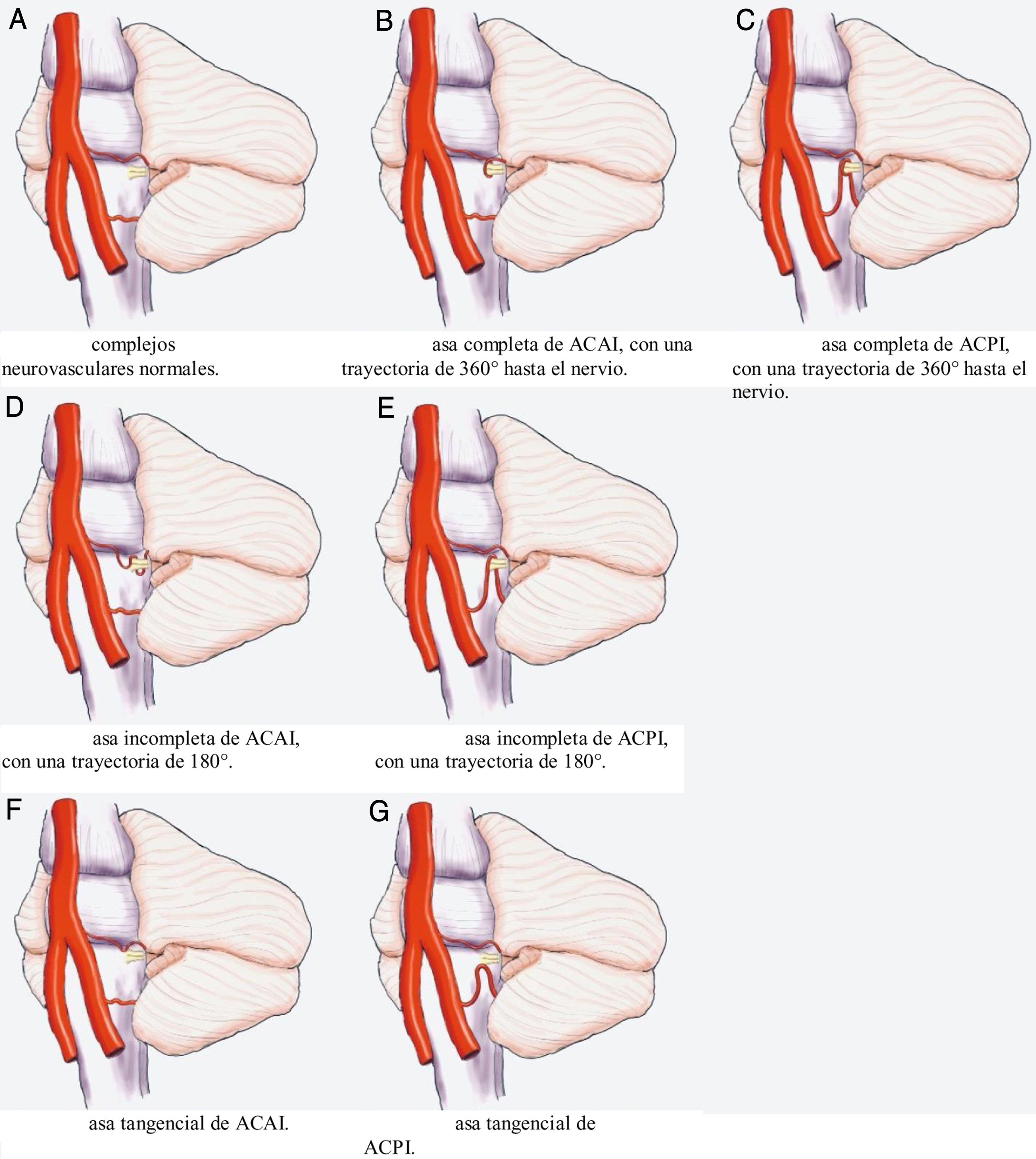 Correlaci n Cl nico radiol gica Del Asa Vascular Del ngulo correlaci-n-cl-nico-radiol-gica-del-asa-vascular-del-ngulo