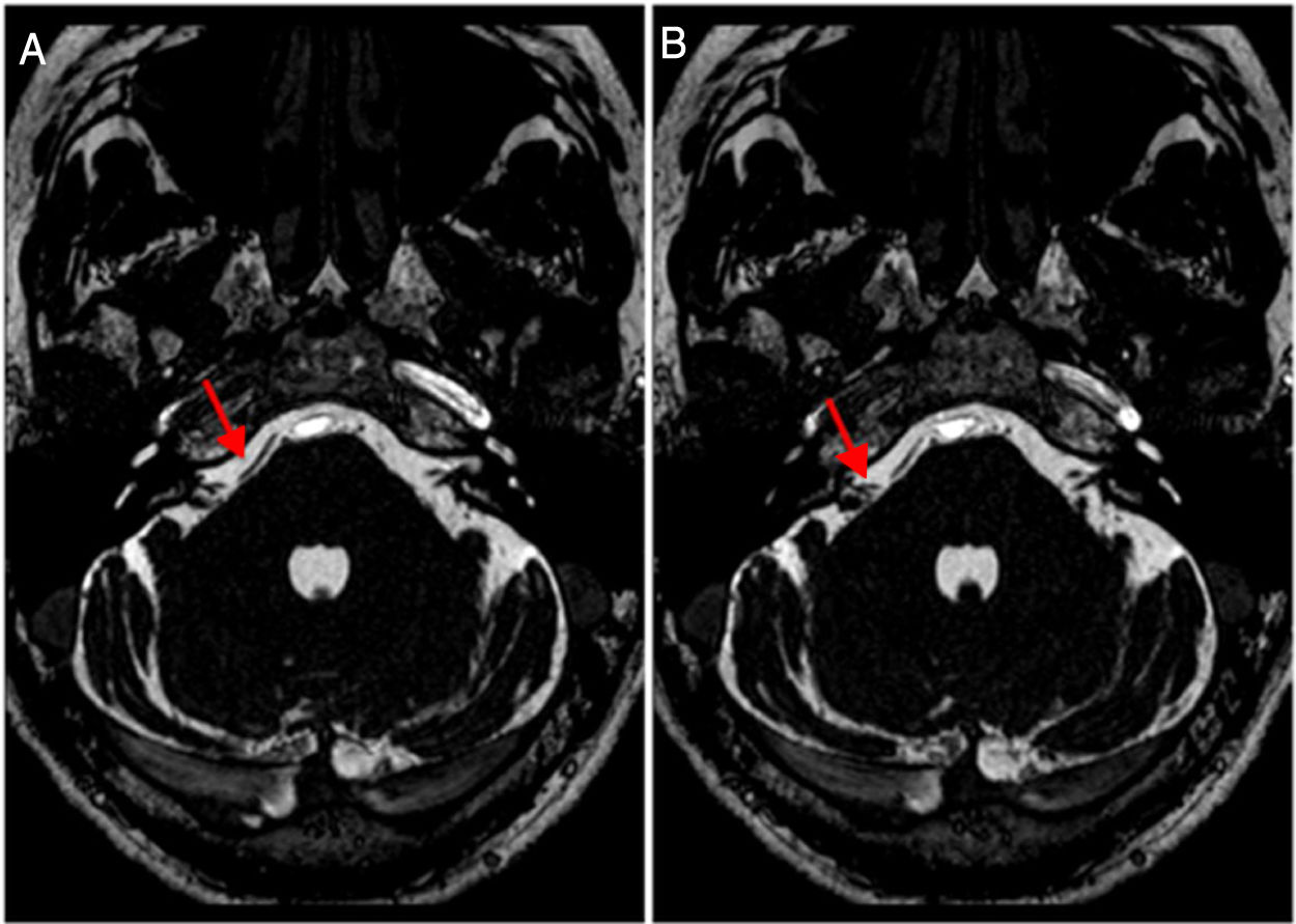 Correlación clínico-radiológica del asa vascular del ángulo ...