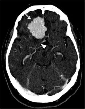 Tomografía computarizada de cráneo con contraste intravenoso, plano axial. Paciente que acude por convulsiones, en el que se objetiva una lesión ocupante de espacio extraaxial frontobasal derecha, con márgenes lobulados bien definidos y captación homogénea del contraste, en relación con meningioma (flecha blanca), con edema vasogénico en el parénquima de vecindad (doble flecha negra) y desviación del uncus derecho hacia la cisterna supraselar (punta de flecha blanca).