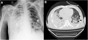 Manifestaciones radiológicas de la melioidosis pulmonar. Serie de casos ...