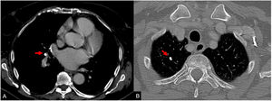 Varón de 73 años de edad con antecedentes de tuberculosis pulmonar. La TC de tórax muestra un ganglio linfático hiliar derecho calcificado (flecha en A) asociado a un ganglio linfático pulmonar calcificado ipsolateral (flecha en B), que representa un complejo de Ranke cicatrizado.