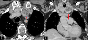 Varón de 83 años de edad. En el mediastino anterior (A) se identifica una lesión heterogénea con zonas quísticas y calcificadas. Si nos fijamos en la reconstrucción coronal (B), las lesiones son claramente adyacentes a la glándula tiroidea y puede establecerse con seguridad un origen tiroideo.