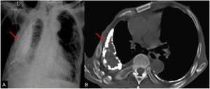 Varón de 85 años de edad con antecedentes patológicos de tuberculosis. Radiografía de tórax (A) y TC torácica axial (B) que muestran extenso fibrotórax extenso derivado de un piotórax tuberculoso antiguo (flechas). La TC muestra mejor el engrosamiento pleural derecho calcificado y la pérdida de volumen asociada, con desplazamiento de las estructuras mediastínicas a la derecha.