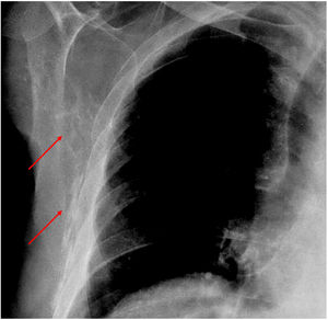 Paciente de 47 años con dermatomiositis. En la radiografía de tórax pueden observarse calcificaciones sutiles en la pared torácica (flechas). Reproducido con permiso del Dr. Francisco Tardáguila, Hospital Povisa, Vigo, España.