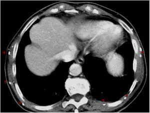 Varón de 74 años con cisticercosis curada. La TC axial muestra múltiples calcificaciones pequeñas (asteriscos) en los músculos de la pared torácica. Reproducido con permiso del Dr. Francisco Tardáguila, Hospital Povisa, Vigo, España.