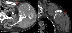 Varón de 63 años de edad que presenta un masa de rápido crecimiento en el brazo izquierdo. La TC (A, axial; B, reconstrucción coronal) muestra una masa heterogénea voluminosa con zonas de calcificación, que corresponden a mineralización de la matriz condroide en este condrosarcoma confirmado por biopsia.