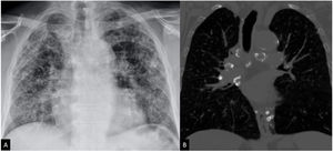 Varón de 67 años de edad con silicosis pulmonar. La radiografía de tórax muestra un patrón micronodular, con algunos nódulos calcificados y calcificaciones mediastínicas. La TC de tórax (B) muestra mejor múltiples ganglios linfáticos mediastínicos calcificados en un patrón «en cáscara de huevo», indicativo de silicosis.