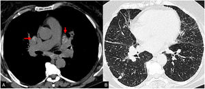 Mujer de 68 años de edad con sarcoidosis pulmonar diagnosticada. La TC de tórax muestra calcificaciones difusas de ganglios linfáticos «a modo de azúcar glasé» (flecha en A). La ventana pulmonar (B) muestra afectación del parénquima pulmonar con micronódulos pulmonares difusos con un patrón perilinfático.