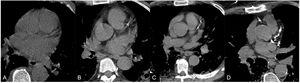 Calcificaciones coronarias en TC torácicas no sincronizadas de 4 pacientes diferentes. A) Ausentes. B) Leves. C) Moderadas. D) Graves.