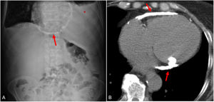 Mujer de 63 años de edad que acude al Servicio de Urgencias por disnea. La radiografía obtenida revela calcificación pericárdica periférica difusa (flecha en A) con derrame pleural derecho concomitante (asterisco en A). La TC sin contraste (B) muestra claramente la calcificación pericárdica (flechas).