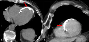 Varón de 89 años de edad con antecedentes de infarto de miocardio en la zona de la arteria descendente anterior izquierda (DAI). La TC sin contraste (A, axial; B, reconstrucción del eje corto) muestra calcificación miocárdica en los segmentos anterior, anteroseptal y apical, que corresponde al territorio de la DAI.