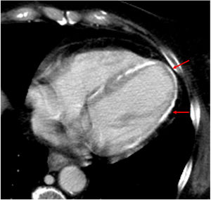 Mujer de 61 años que presenta calcificaciones subepicárdicas difusas 6 semanas después de sufrir un episodio de choque séptico con bacteriemia por Enterococcus faecium, seguido de tratamiento de inducción por leucemia mieloide aguda. Caso reproducido con permiso del Dr. Daniel Castellón, Hospital Universitario de Bellvitge, Barcelona.