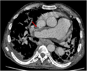 Mujer de 70 años de edad con HPTC. La TC muestra un trombo parcialmente calcificado en la arteria pulmonar derecha (flecha), que sugiere HPTC. Además, se observa una dilatación acusada de la arteria pulmonar principal, un signo de hipertensión pulmonar.