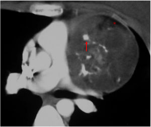 Mujer de 33 años de edad con disnea a la que se hizo una angiografía con TC pulmonar de urgencia para descartar una embolia pulmonar. La TC reveló una masa mediastínica anterior con áreas de calcificación (flecha) y densidad adiposa (asterisco), típicas de un teratoma.