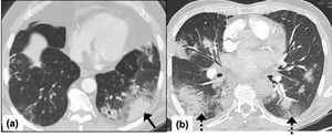 Aspergilosis angioinvasiva en un hombre de 69 años con neumonía por COVID-19 que requirió ventilación no invasiva e ingreso en la UCI. TAC de tórax en el día 10 desde el inicio de los síntomas que muestra en el lóbulo inferior izquierdo una consolidación periférica en forma de cuña con una opacidad en vidrio esmerilado circundante acorde con un infarto pulmonar y un signo de halo circundante debido a una hemorragia pulmonar (flecha) (a); imagen axial que presenta consolidaciones multifocales subpleurales periféricas bilaterales (flecha discontinua) compatibles con neumonía subyacente por COVID-19 (b).