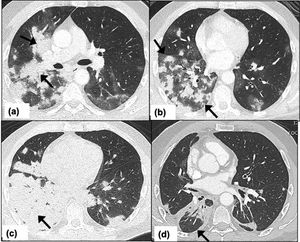 Criptococosis pulmonar en un hombre de 54 años que recibe tratamiento inmunosupresor por antecedentes médicos de enfermedad inflamatoria intestinal. El paciente se presenta en urgencias con síntomas moderados de COVID-19. TAC de tórax en el día 10: imagen de TAC axial a nivel de la carina que muestra nódulos confluentes que forman una consolidación peribronquial con opacidades en vidrio esmerilado circundantes (flechas) (a); imagen de TAC axial que muestra múltiples nódulos con halo en vidrio esmerilado en los lóbulos inferiores bilaterales (flechas) (b); imagen de TAC axial tomada 2 semanas después que muestra una consolidación lobular completa en el lóbulo inferior derecho, lo cual sugiere una progresión significativa en este intervalo (flecha) (c), e imagen de TAC axial del tórax 2 meses después del inicio de los síntomas que muestra una mejoría significativa en este intervalo con consolidación peribronquial residual en el lóbulo inferior derecho (flecha) (d).