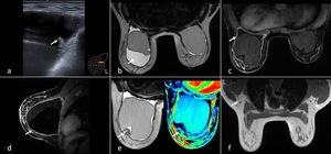 a) Ecografía en cuadrante superoexterno izquierdo. Colección periprotésica con algún área de contenido ecogénico en el líquido (flecha) y una superficie interna de la cápsula fibrosa marcadamente irregular. b) Resonancia magnética (RM) axial potenciada en T2. Se muestra colección líquida periprotésica en mama izquierda (flecha). Mínima cantidad normal de líquido periprotésico derecho. c) RM axial potenciada en T1 con saturación grasa y tras administración de contraste. Intensa captación irregular de la cápsula periprotésica izquierda (flecha). No hay masas ni adenopatías. d) RM sagital potenciada en T1 con saturación grasa y tras administración de contraste que muestra captación difusa e irregular de la cápsula periprotésica (flecha). e) RM axial T2 que muestra un área seudonodular de tejido de baja intensidad de señal adyacente a la cápsula fibrosa (correlación Figura 1a) y mapa de color que demuestra su ausencia de vascularización (flecha). f) RM axial T1 que demuestra la ausencia de adenopatías (flechas).