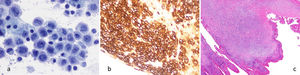 a) Preparación de cytospin con celularidad neoplásica. Células grandes, atípicas, con formas “Hall Mark”. (Papanicolaou x400). b) Bloque celular citológico. Difusa e intensa expresión de CD30 citoplásmica y paranuclear en celularidad neoplásica. (IHQ-CD30 x200).c) Cápsula periprotésica con un nódulo de células tumorales de 3×2 mm de diámetro (correlación figuras 1a, 1e y 3b). (HE, x40).
