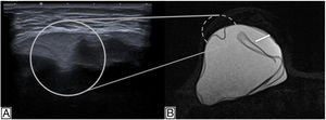 A) Ecografía. B) Resonancia magnética mamaria. Secuencia Silicona Only en la misma paciente con signos de rotura intracapsular: signo de la cerradura (figura ampliada) y signo de linguini (flecha blanca) en el implante derecho.