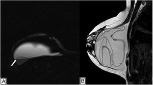 Resonancia magnética mamaria. A) Secuencia Silicona Only que muestra imagen laminar posterior y externa de igual intensidad de señal que la silicona como resultado de trasudación de silicona intracapsular (flecha blanca). B) Secuencia T2 sagital con líneas hipointensas como signo de linguini en RIC.
