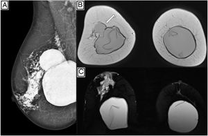 A) Incidencia MLO mamográfica derecha con múltiples imágenes nodulares hiperdensas, en región centromamaria y hacia plano posterior. B) Resonancia magnética (RM): T2 coronal. Herniación del implante derecho hacia el CSE (flecha blanca). C) RIC bilateral. RM: Silicona Only axial con imágenes hiperintensas en región centromamaria derecha que se extienden hacia el pezón, como signo de REC. CSE: cuadrante superoexterno; MLO: medio lateral oblicua.