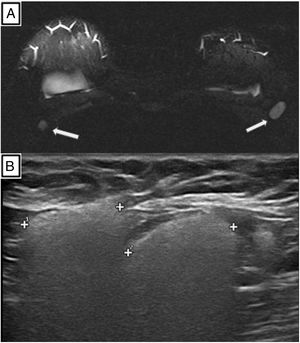 A) Secuencia Silicona Only axial. Ganglios en ambas axilas, hiperintensos, compatibles con infiltración por silicona (flechas blancas). b) Ganglios axilares con aspecto “en tormenta de nieve”, atribuible a silicona libre intraganglionar.