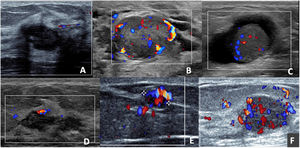 Adenomioepiteliomas en modo Doppler color. A) Nódulo ovalado, hipoecogénico, circunscrito y no vascularizado. B) Nódulo ovalado, hipoecogénico, circunscrito, que presenta vascularización peri e intranodular. C) Nódulo ovalado, sólido-quístico, con vascularización intranodular en la porción sólida. D) Nódulo con vascularización exclusivamente capsular. E) Nódulo ovalado, con marcada vascularización; se muestra la presencia de un pedículo único que se dirige al nódulo. F) Nódulo ovalado, hipoecogénico, con marcada vascularización nodular y capsular con presencia de múltiples pedículos tortuosos ingresando al nódulo.