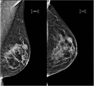 Mamografía digital. Proyecciones oblicua mediolateral y craneocaudal de la mama izquierda. Se identifica un nódulo ovalado, circunscrito e isodenso en el cuadrante superior externo de la mama izquierda.