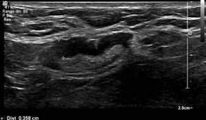 Paciente de 38 años con diagnóstico de carcinoma lobulillar infiltrante de grado 3, luminal B HER2 negativo. Ultrasonido axilar con 1 ganglio con engrosamiento cortical de 3,6mm. Cirugía de ganglio centinela: 3/5 con micrometástasis.