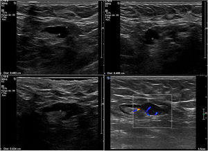 Paciente de 33 años con diagnóstico de carcinoma ductal infiltrante mediana a pobremente diferenciado de grado 3, HER2 positivo. Ultrasonido axilar con 4 adenopatías con engrosamiento cortical difuso de más de 4 mm. Linfadenectomía: 3/25 ganglios con macrometástasis.
