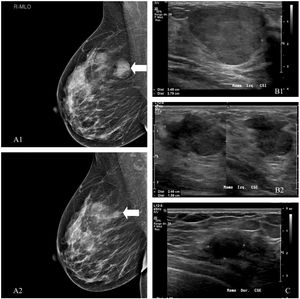 Paciente 1. A) Tras la crioablación, en la mamografía se ha descrito una ligera densidad residual sin calcificaciones, como en este caso de un tumor filodes benigno. Mostramos la mamografía inicial (A1) y la realizada a los 24 meses (A2). Pacientes 2 (B) y 3 (C). En la ecografía, a los 6 meses la mayoría de las lesiones son más pequeñas, pero a veces pueden ser ligeramente mayores o haber desaparecido completamente. El fibroadenoma residual puede mostrar una ecoestructura heterogénea, en relación con detritos, o bandas ecogénicas secundarias a necrosis coagulativa (B1: ecografía inicial y B2: estudio de control). Es posible ver una cápsula gruesa de tejido ecogénico que representa edema y hemorragia. A los 12 meses, los cambios por edema y necrosis son menos evidentes. El nódulo residual puede aparecer como una lesión sutil con bordes mal definidos y difícil de medir como el tumor filodes benigno de la imagen (C).