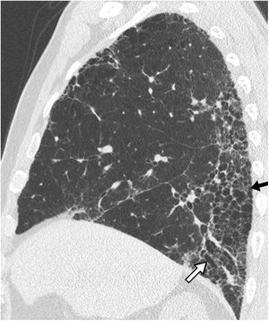 Patrón típico de neumonía intersticial usual en paciente con fibrosis pulmonar idiopática. Tomografía computarizada de alta resolución en reconstrucción multiplanar y plano coronal de pulmón derecho, que muestra abundantes imágenes de patrón en panal (flecha negra) y bronquiectasias de tracción (flecha blanca), predominantemente localizadas en porciones posteriores e inferiores.