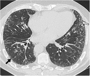 Patrón de probable neumonía intersticial usual. Tomografía computarizada de alta resolución en plano transverso, incluyendo bases pulmonares, que muestra patrón reticular (flecha negra) y bronquiolectasias de tracción (flecha blanca) de distribución bilateral, periférica y subpleural. Destaca la ausencia de patrón en panal.