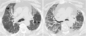 Patrón inconsistente con neumonía intersticial usual en paciente con neumonitis por hipersensibilidad diagnosticada mediante biopsia pulmonar. Tomografía computarizada de alta resolución en inspiración (A) donde destaca la presencia de retículo, bronquiectasias de tracción (flecha negra) y áreas de hipoatenuación del parénquima pulmonar en relación con patrón de perfusión en mosaico (puntas de flecha). B) El corte en espiración al mismo nivel destaca áreas de atrapamiento aéreo bilateral (flechas).