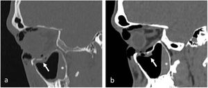 Fractura orbitaria. a) Plano sagital, ventana de hueso. b) Plano sagital, ventana de partes blandas. Hundimiento del suelo orbitario (flechas) sin atrapamiento muscular. Nivel hidroaéreo por hemoseno (asteriscos).