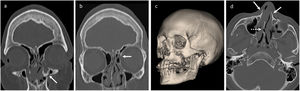 Fractura naso-órbito-etmoidal. a) Plano coronal, ventana de hueso. Fractura de conducto lacrimal (flecha). b) Plano coronal, ventana de hueso. Fractura de lámina papirácea (flecha). c) Reconstrucción 3D volumétrica. d) Plano axial, ventana de hueso. Fractura de huesos nasales (flechas) y de tabique nasal (flecha discontinua).