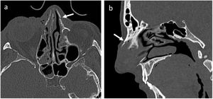 Fractura de hueso nasal (flechas). a) Plano axial, ventana de hueso. b) Plano sagital, ventana de hueso.