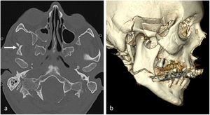 Fracturas de complejo cigomático maxilar, pared lateral orbitaria, hueso temporal y ángulo mandibular. a) Plano axial, ventana de hueso. Fractura de arco cigomático con conminución y hundimiento (flecha). b) Reconstrucción 3D volumétrica.