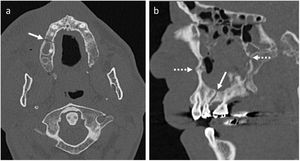 Fractura de segmento maxilar oclusor (flechas). a) Plano axial, ventana de hueso. b) Plano sagital, ventana de hueso. Fractura de paredes anterior y posterior de seno maxilar (flechas discontinuas).