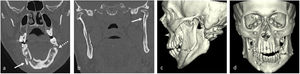 Fractura mandibular. a) Plano coronal, ventana de hueso. Fracturas parasinfisaria derecha (flecha) y en ángulo izquierdo con afectación del canal del nervio dentario inferior (flecha discontinua). b) Plano coronal, ventana de hueso. Fractura sagital de cóndilo izquierdo no desplazada (flecha). c y d) Reconstrucciones 3D volumétricas.