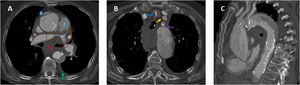 Disección aguda de aorta torácica tipo A de Stanford con signos de rotura aórtica. A) Imagen axial poscontraste en fase arterial donde observamos infiltración hemática del mediastino (flecha roja), pequeño hemotórax izquierdo (flecha verde) e irregularidad de la pared de la aorta ascendente con 2focos de extravasado de contraste procedentes de la luz falsa (puntos azules) como signos de rotura aórtica. También había pequeño hemopericardio no mostrado. Asimismo, hay una disminución de calibre de las arterias pulmonares proximales (línea discontinua marrón) provocada por la extensión subadventicial del sangrado o la compresión ejercida por el hematoma mediastínico. B) Imagen axial poscontraste en fase arterial en la que se muestra la extensión de la disección al tronco arterial braquiocefálico derecho (flecha azul), a la arteria carótida izquierda (flecha naranja) y a la arteria subclavia izquierda (flecha morada). C) Reconstrucción MPR en el plano sagital donde apreciamos mejor la extensión de la disección a la largo de la aorta torácica (ascendente, cayado y descendente) y a troncos supraaórticos.