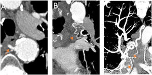 Arterias bronquiales patológicas. angio-TCMD en fase arterial sistémica. A) Corte axial en el que se identifica una dilatación de la arteria bronquial derecha en su origen, mayor de 2mm (flecha naranja). B y C) Corte coronal y MIP (proyección de máxima intensidad). B) Se observa la arteria bronquial izquierda dilatada y tortuosa en el hilio pulmonar (punta de flecha). C) se visualiza la arteria bronquial derecha ortotópica dilatada y tortuosa, visible en todo su trayecto (flechas cortas).
