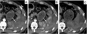 Cortes axiales de TC abdominopélvico en fases arterial, venosa y tardía, en paciente con trauma abdominal cerrado. A) Fase arterial. B) Fase venosa. C) Fase tardía. Lesión vascular contenida (flecha continua): lesión hiperdensa en fase arterial que disminuye su atenuación en fase venosa y desaparece en fase tardía. Sangrado activo al peritoneo (flecha discontinua): lesión hiperdensa en fase arterial que aumenta su atenuación y su tamaño en fases venosa y tardía, por sí solo constituye un grado v en la clasificación AAST. El parénquima esplénico debe valorarse en la fase venosa; muestra un estallido esplénico rodeado de hemoperitoneo y de coágulo centinela (asterisco). También existen fracturas costales (cabeza de flecha).