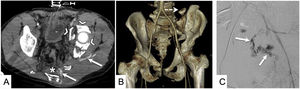 Accidente de tráfico con traumatismo pélvico grave. A) TC de pelvis en fase venosa. Pelvis con múltiples fragmentos (cabezas de flecha) y con focos de sangrado activo (flechas) y hematoma extraperitoneal (asterisco). B) Las reconstrucciones volumétricas pueden ser de ayuda a la hora de describir y clasificar las fracturas del anillo pélvico. La rotura de las apófisis transversas de L5 (flecha punteada) tiene importancia a la hora de fijar quirúrgicamente la pelvis. C) Arteriografía a través de arteria femoral derecha. Se confirma un gran foco de sangrado activo (flechas).