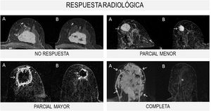 Grupos de respuesta radiológica según la Unión Internacional de Control del Cáncer. A) RM preterapia primaria sistémica. B) RM posterapia primaria sistémica.