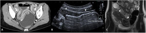 Estenosis ileales. A) Corte axial de una TC abdominal con contraste por vía intravenosa que muestra un segmento largo de íleon medio en la pelvis de paredes engrosadas y aspecto estenótico (flecha), que condiciona una severa dilatación preestenótica de unos 5cm de diámetro (cabeza de flecha). B) US intestinal de otro paciente que muestra una sección longitudinal de íleon distal, observándose un segmento de aspecto estenótico y paredes engrosadas (flecha) que condiciona una grave dilatación (cabeza de flecha). C) Secuencia coronal T2 de la enterografía por RM del mismo paciente de la imagen B, observándose el segmento estenótico (flecha) y la dilatación preestenótica (cabeza de flecha).