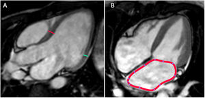 A) Medidas para el análisis de grosor miocárdico y masa cardíaca. El plano 3 cámaras es idóneo para hacer el cálculo del grosor del septo interventricular (línea roja) y de la pared posterior del VI (línea verde). B) La medición de las aurículas debe hacerse en el plano 4 cámaras y calcularse el área (línea roja).
