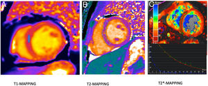 Mapas paramétricos. A) T1-mapping (native) realizado con secuencia Molli. Medición con ROI en el septo interventricular con un valor de 950 ms (normal). B) T2-mapping. Estudio para valoración de miocarditis (edema e inflamación ventricular). Se realiza medida con una ROI amplia que abarque el septo e incluso son necesarias varias ROI en los diferentes segmentos ventriculares. El resultado fue de 40 ms (normal). C) T2*-mapping para valoración de sobrecarga férrica en paciente con talasemia. El valor de la ROI en el septo fue de 8 ms (sobrecarga férrica). En el recuadro de abajo se muestran las curvas con la caída de señal en los diferentes tiempos de eco.
