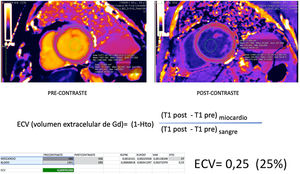 Valoración del volumen extracelular miocárdico (VEC). A) Se muestra plano en eje corto con secuencia T1-mapping sin contraste IV (también llamada “native”) B) En el mismo plano se adquiere secuencia T1-mapping tras la administración de contraste. El cálculo del VEC se obtiene con un ratio entre los valores T1 del miocardio pre y postcontraste con los valores T1 de la sangre en la luz intraventricular. Debe introducirse el valor del hematocrito del paciente para realizas el cálculo según la fórmula de la figura. Este valor representa el espacio extracelular del miocardio que no debe exceder un 25%.