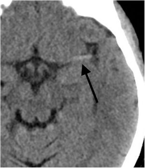 TC craneal sin contraste. Signo de la cerebral media hiperdensa o dot sign en un paciente varón de 62 años con clínica deficitaria del territorio de la arteria cerebral media izquierda.